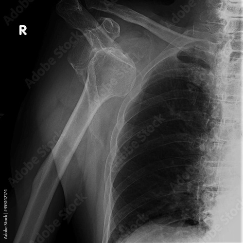 right shoulder dislocation,Xray 
