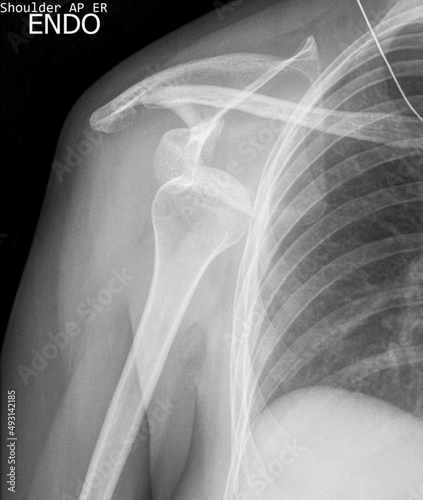 right shoulder dislocation,Xray 