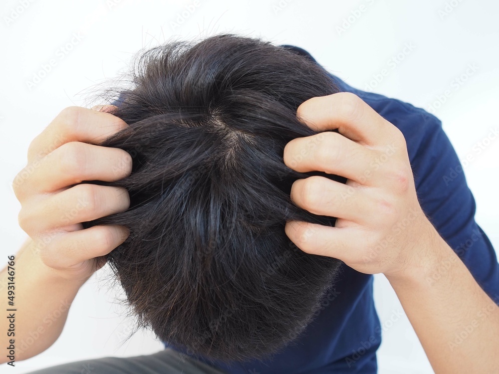 Fototapeta premium Dandruff or lice in his hair man and scratching her head for healthcare concept. closeup photo.