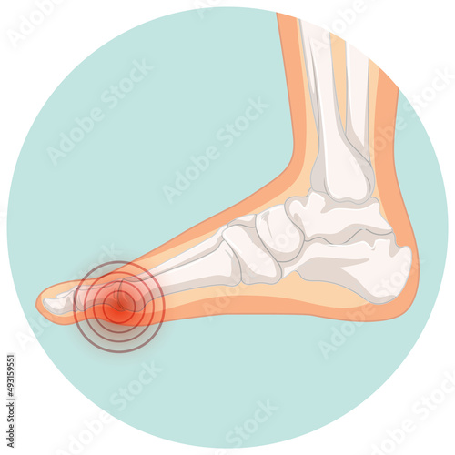 Hallux valgus types in circle template
