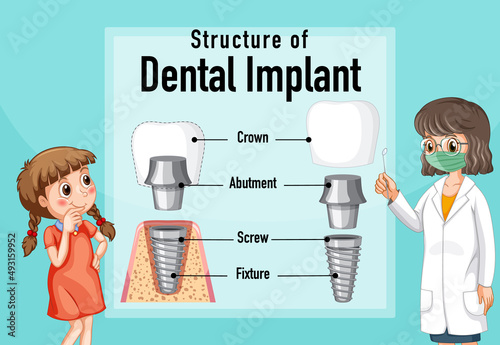 Infographic of human in structure of the dental implant