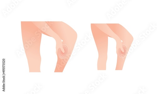 People with leg calf acute muscle and waist with body aches. Medical health care concept. Muscle strain. vector illustration isolated