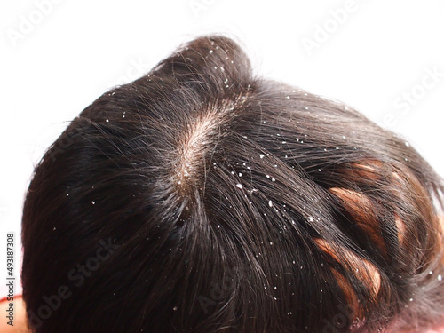 Closeup Woman with dandruff in her hair. Problem health care concept. photo