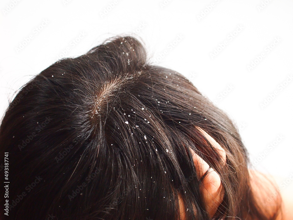Closeup Woman with dandruff in her hair. Problem health care concept. - obrazy, fototapety, plakaty 