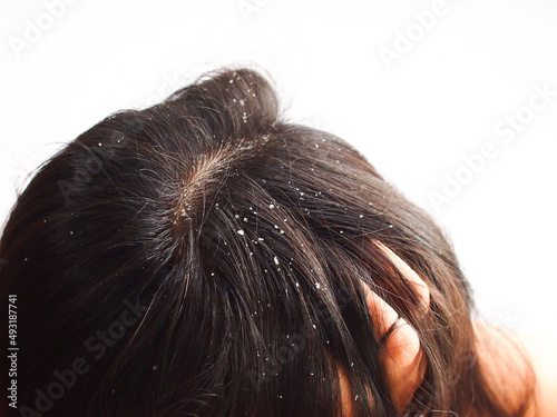 Closeup Woman with dandruff in her hair. Problem health care concept. photo