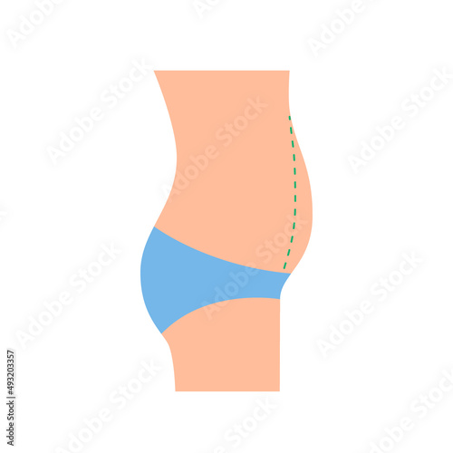 Protruding belly of woman, correction big fat belly, tummy tuck. Overweight. Loss weight, reduce volume figure body, surgery plastic. Vector side view illustration
