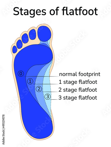Illustration of the progression stage of flat feet.
Different stages of flat feet are superimposed on the image of the imprint of a healthy foot.  photo