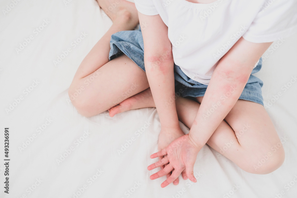 The child scratches atopic skin. The child applies a special cream to atopic skin. Dermatitis, diathesis, allergy on the child's body.