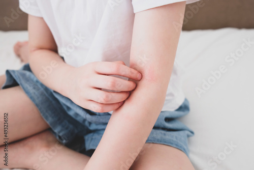 The child scratches atopic skin. Dermatitis, diathesis, allergy on the child's body.