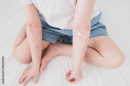 The child scratches atopic skin. The child applies a special cream to atopic skin. Dermatitis, diathesis, allergy on the child's body.