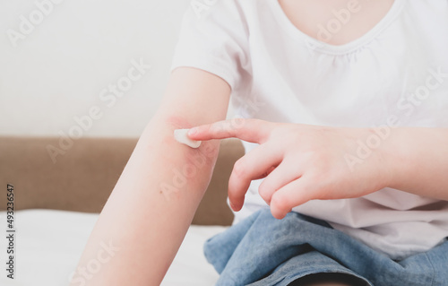 The child scratches atopic skin. The child applies a special cream to atopic skin. Dermatitis, diathesis, allergy on the child's body.