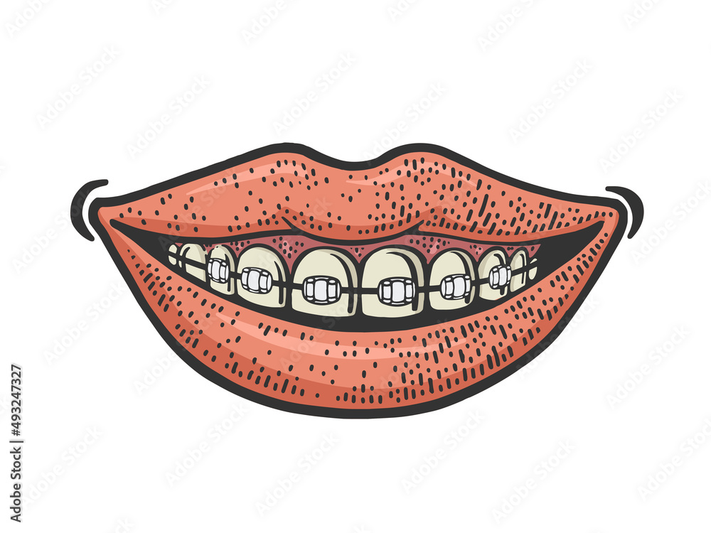 Dental braces smile line art color sketch engraving vector illustration. T-shirt apparel print design. Scratch board imitation. Black and white hand drawn image. Dental braces smile line art color sketch engraving vector illustration. T-shirt apparel print design. Scratch board imitation. Black and white hand drawn image.