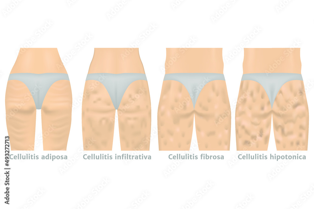 stages of cellulite. Women's hips and stages of obesity. Overweight ...