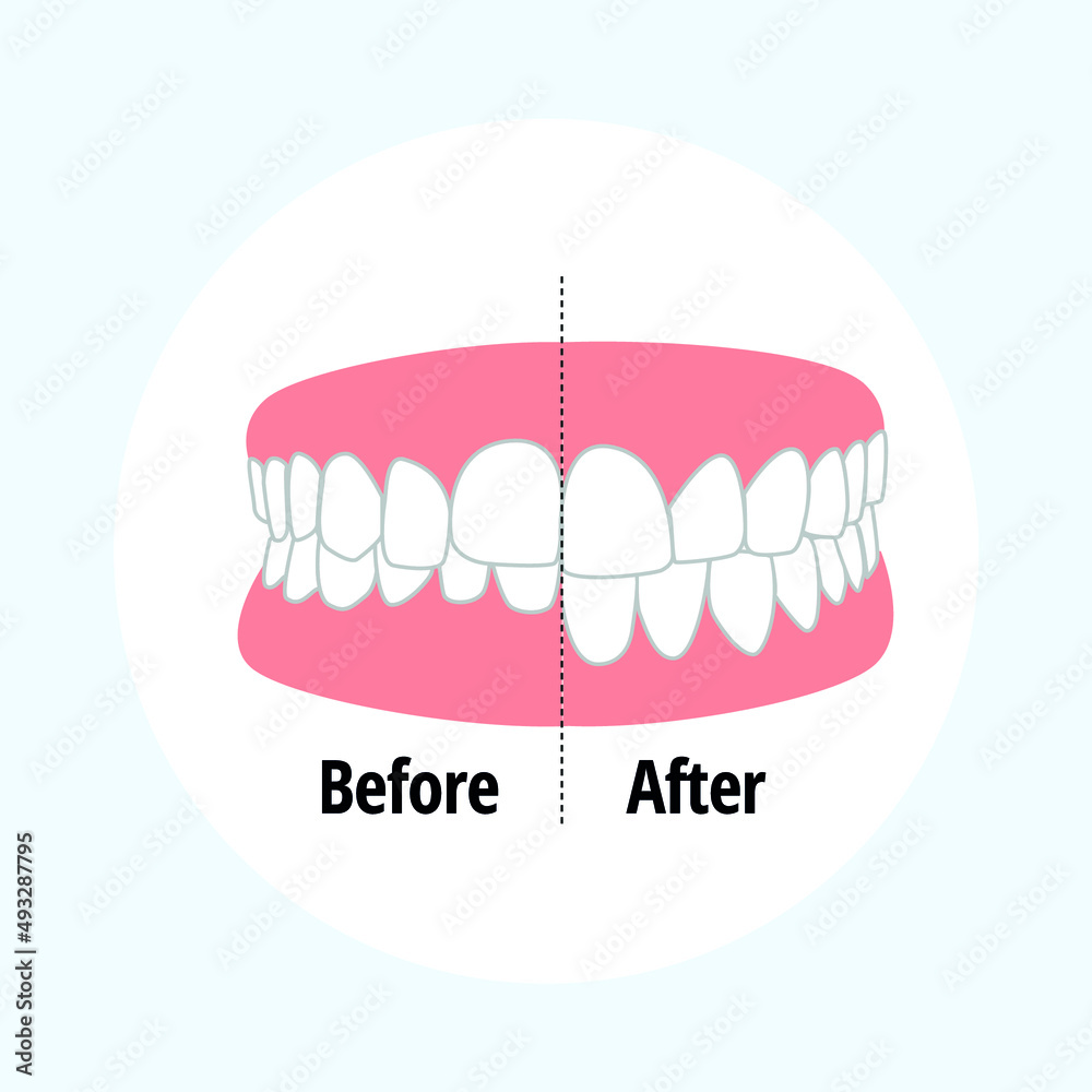 Malocclusion Overbite. Dental problem vector illustration. Dental care concept. Malocclusion Overbite. Dental problem vector illustration. Dental care concept.