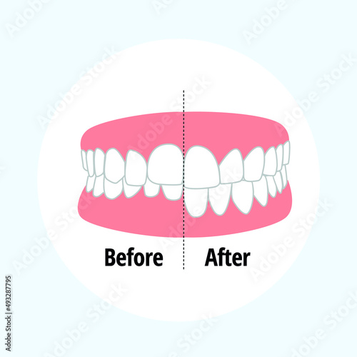 Malocclusion Overbite. Dental problem vector illustration. Dental care concept.