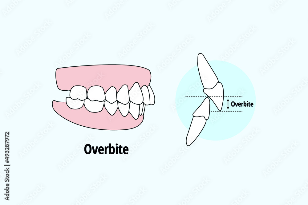 Lateral Overbite. Dental problem vector illustration. Dental care