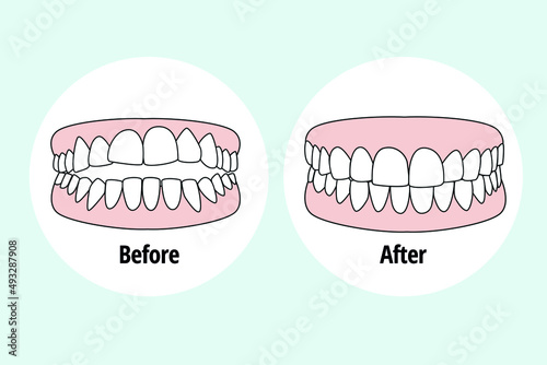 Malocclusion Crowding. Dental problem vector illustration. Dental care concept.