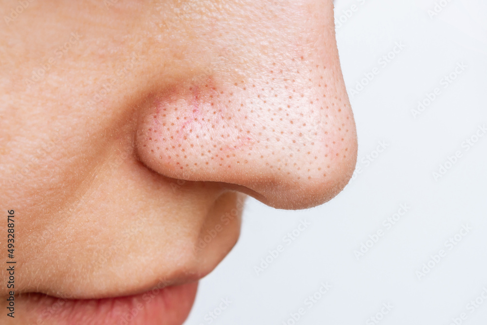 Close-up of a woman's nose with black heads or black dots isolated on a white background. Acne problem, comedones. Enlarged pores on the face. Cosmetology concept. Blackheads on oily skin Stock