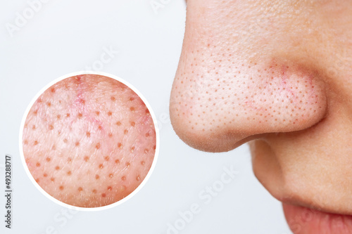Female nose with blackheads or black dots and magnifying glass with an enlarged image of the pores on the face isolated on a white background. Acne problem, comedones. Cosmetology dermatology concept