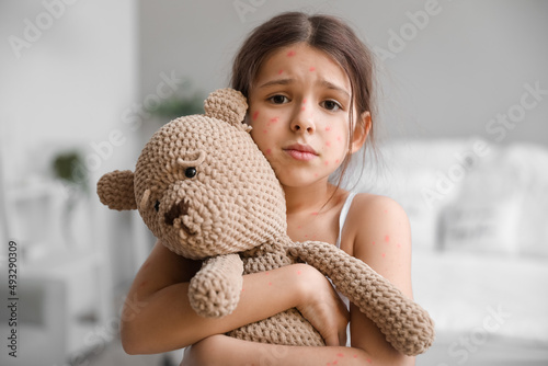 Little girl ill with chickenpox  at home