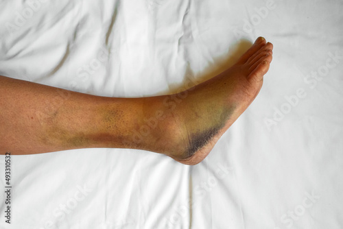 Female leg with bruises and swelling. photo