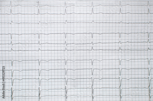 Cardiogram showing myocardial infarction photo