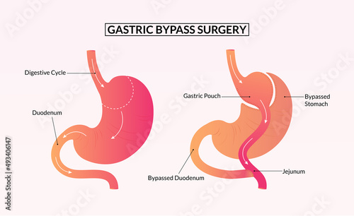 Gastric bypass surgery before and after medical illustration. photo