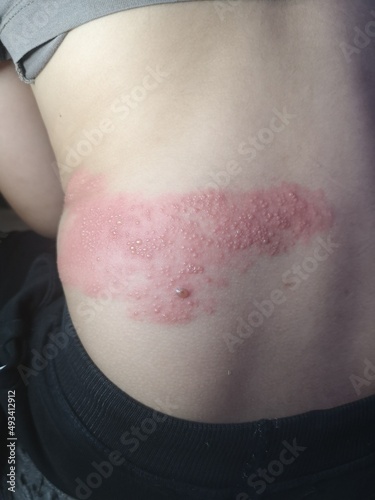 Fotografie Shingles viral infection caused by the varicella-zoster virus on kid body