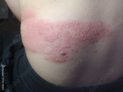 Shingles viral infection caused by the varicella-zoster virus on kid body