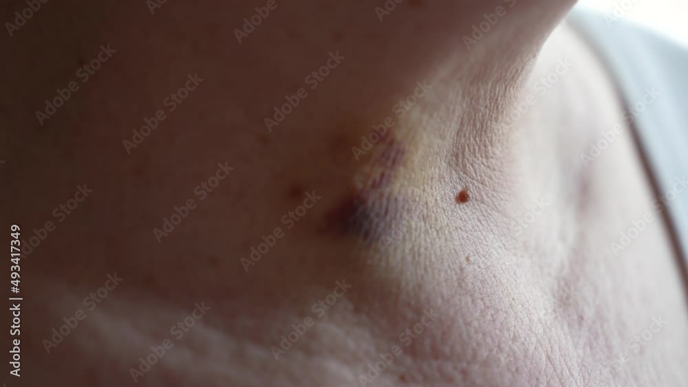 bruises on the neck of a woman as a consequence of laser removal of a benign tumor of the thyroid gland bruises on the neck of a woman as a consequence of laser removal of a benign tumor of the thyroid gland