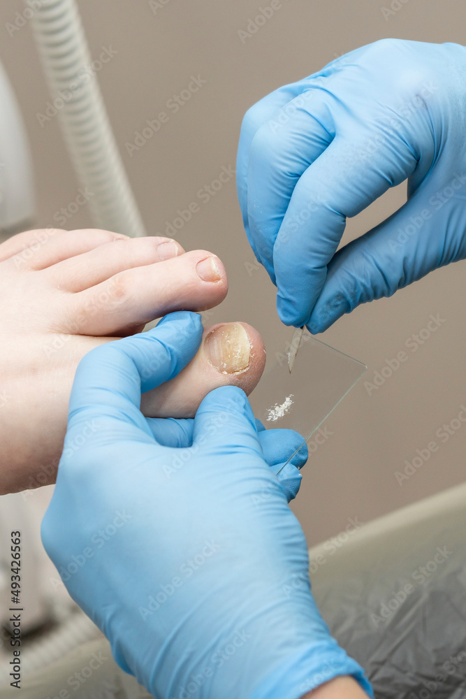 Fototapeta premium Analysis of the problem nail scraping of the female nail for further diagnosis.