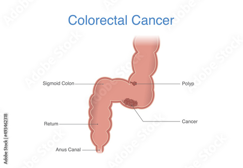 Human Colon or rectum has cancer cells that grow out of control. Colorectal cancer on the passageway that connects the colon to the anus.