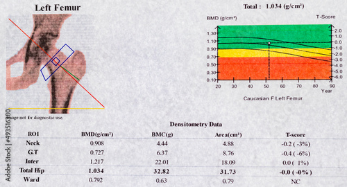 DEXA densitometry report of left femoral scan; diagram and curve of values ​​used to investigate osteoporosis in menopausal women photo