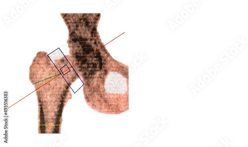 Medical scan of right femoral bone density. Diagnosis of osteoporosis in women over 50 at menopause. Copy space photo