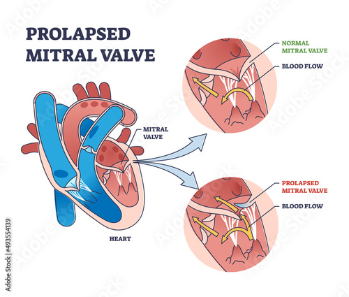 Prolapsed mitral valve heart disease comparison with normal outline diagram. Labeled educational cardio dysfunction with medical chamber closure differences because of illness vector illustration. photo