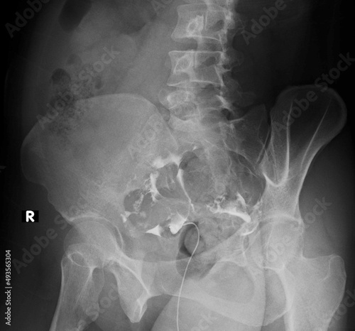 x-ray image of  Normal Hysterosalpingography (HSG) 
 photo