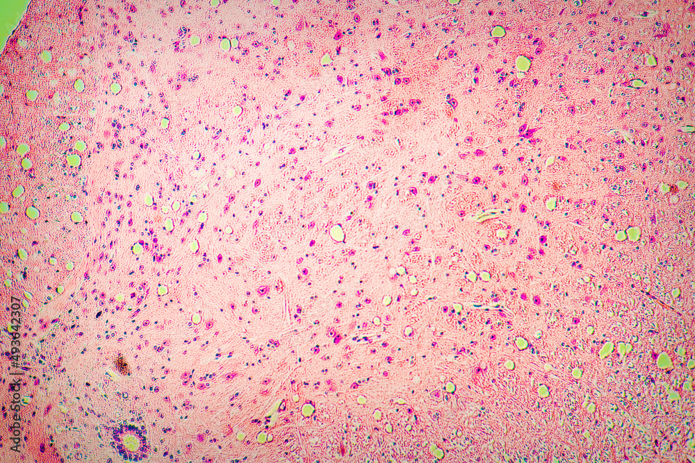 tissue slice biopsy to check for a malignant tumor. View in a microscope