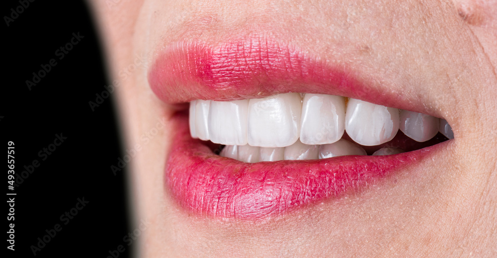 Obraz premium ceramic crowns and veneers b3 color