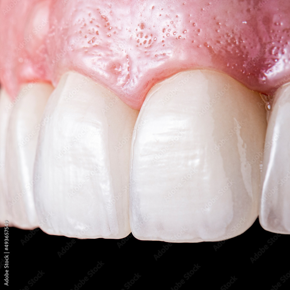 Fototapeta premium ceramic crowns and veneers b3 color