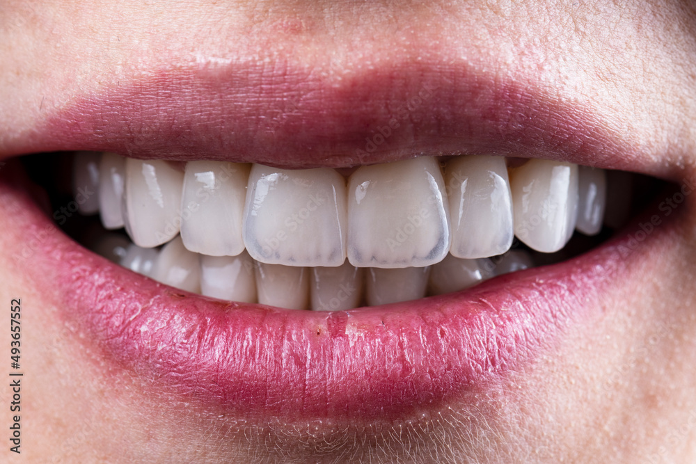 Fototapeta premium ceramic crowns and veneers b3 color