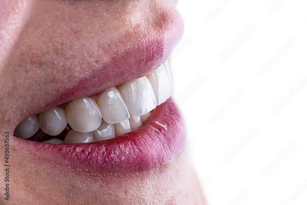 Obraz premium ceramic crowns and veneers b3 color