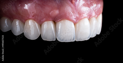 ceramic crowns and veneers b3 color