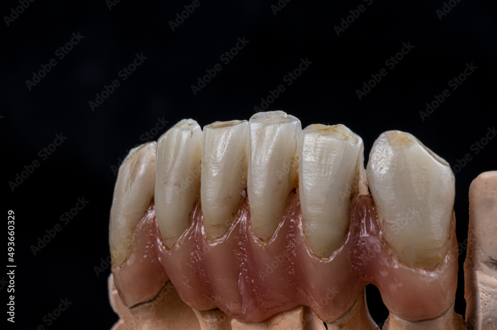 super natural metal ceramic bridge on implants super natural metal ceramic bridge on implants