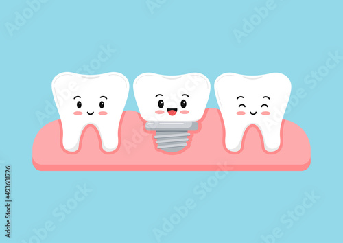 Tooth and dental implant in gum isolated on blue background. Healthy human teeth and implant prosthesis concept. Flat design cartoon style vector orthodontist