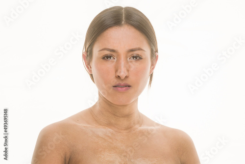 Latin honduras female with scleroderma autoimmune skin disease. Body positive unaltered skincare photo