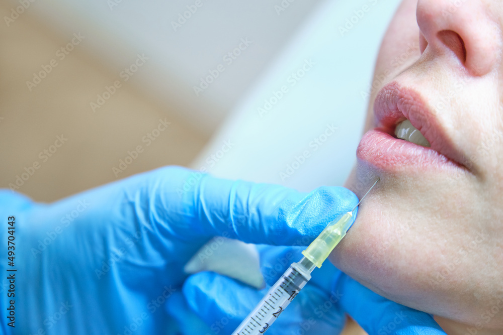 botulinum toxin lip volumization botulinum toxin lip volumization