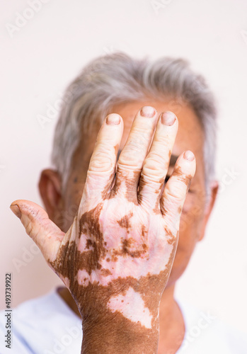 Vitiligo disease on old hand, some part of skin are tanned and the others are white by vitiligo symptoms, caucasian hand.