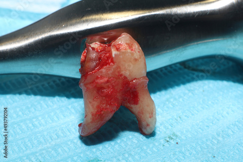 An extracted wisdom tooth on a sterile medical paper sheet