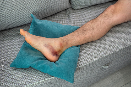Ankle injury with dislocation and sprains. Fracture or Leg sprain injury of young sports man.  photo