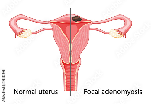 Adenomyosis Focal Human anatomy Female reproductive Sick system vs versus normal. Compared educational healthy and abnormal anatomy organs uterus icon flat cartoon vector medical illustration isolated